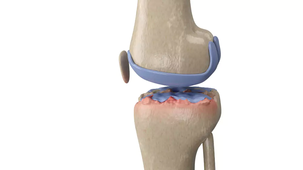 Meniscus Repai