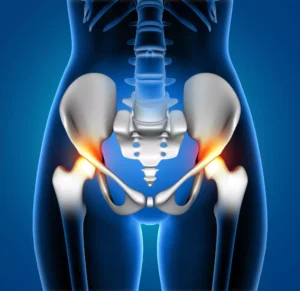 Total Hip Replacement